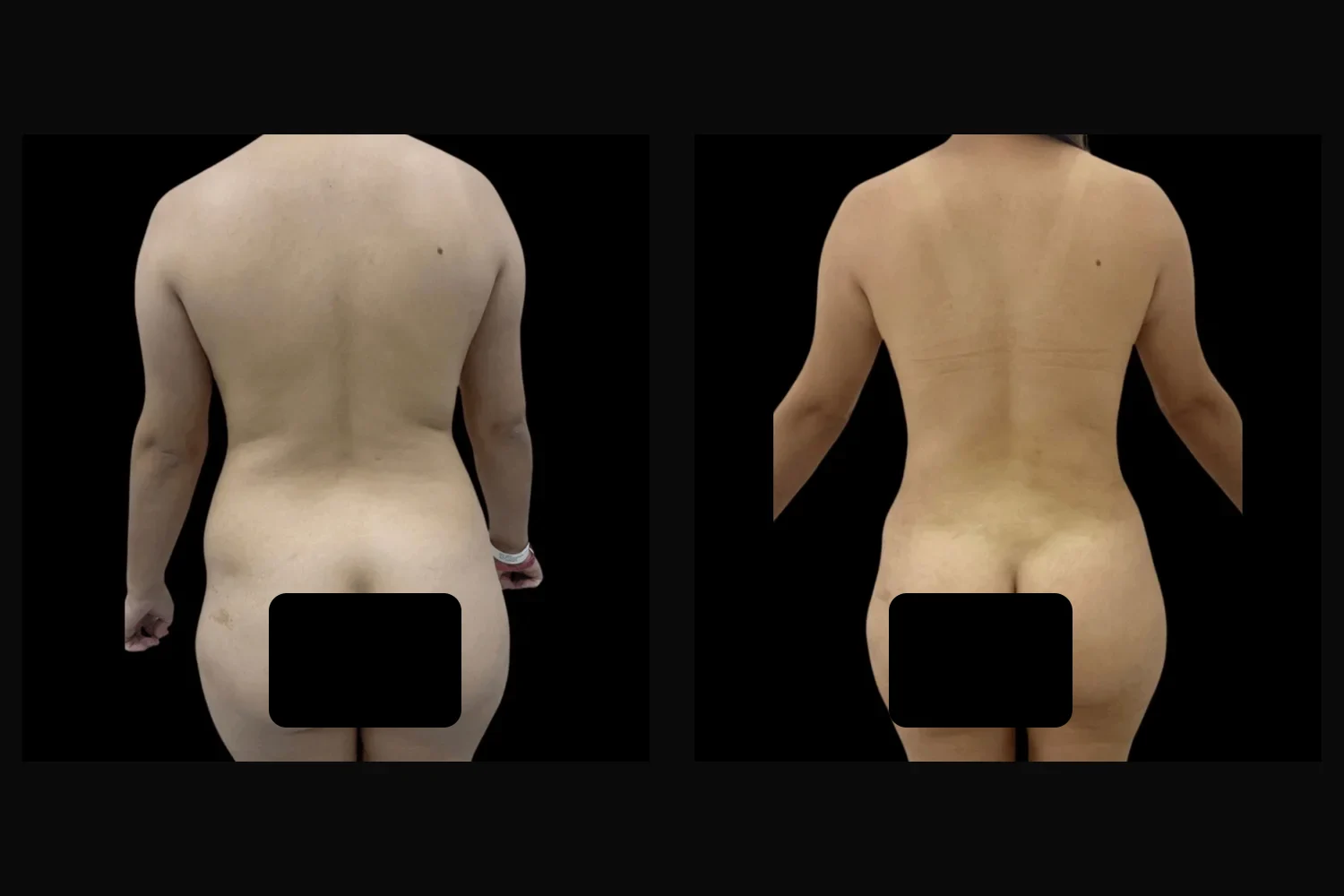 Brazilian Butt Lift (BBL)