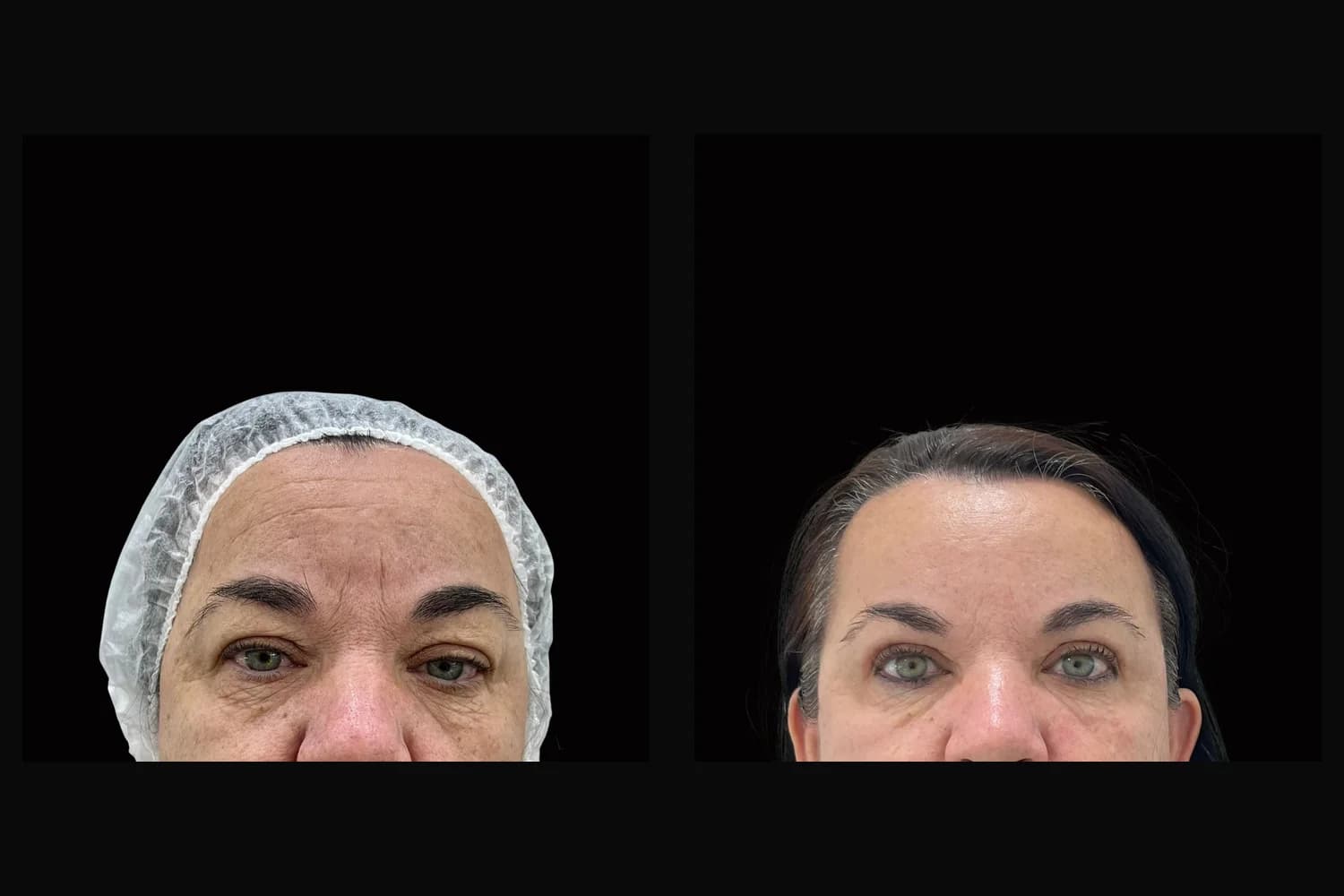 Blefaroplastia