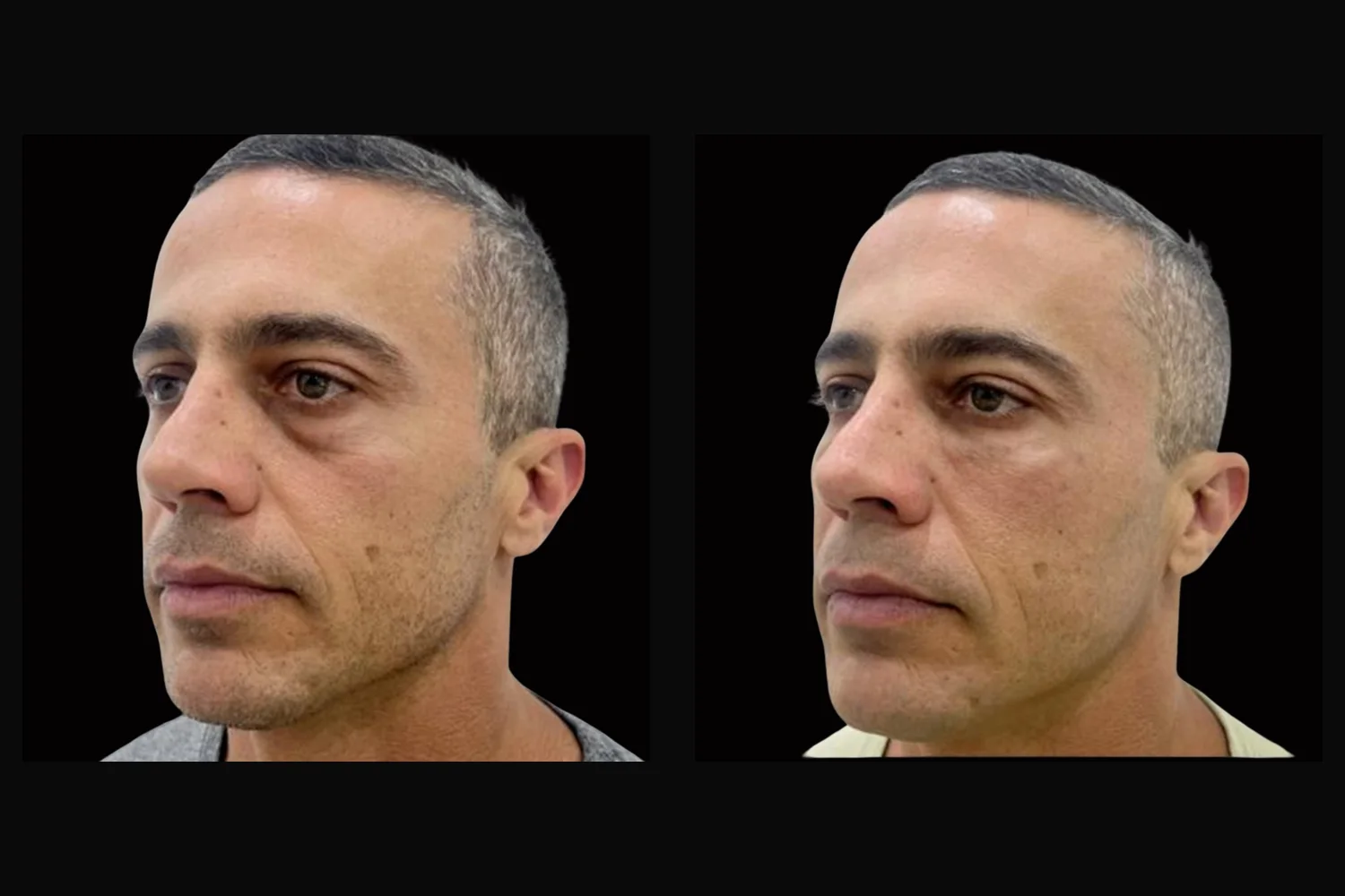 Blefaroplastia