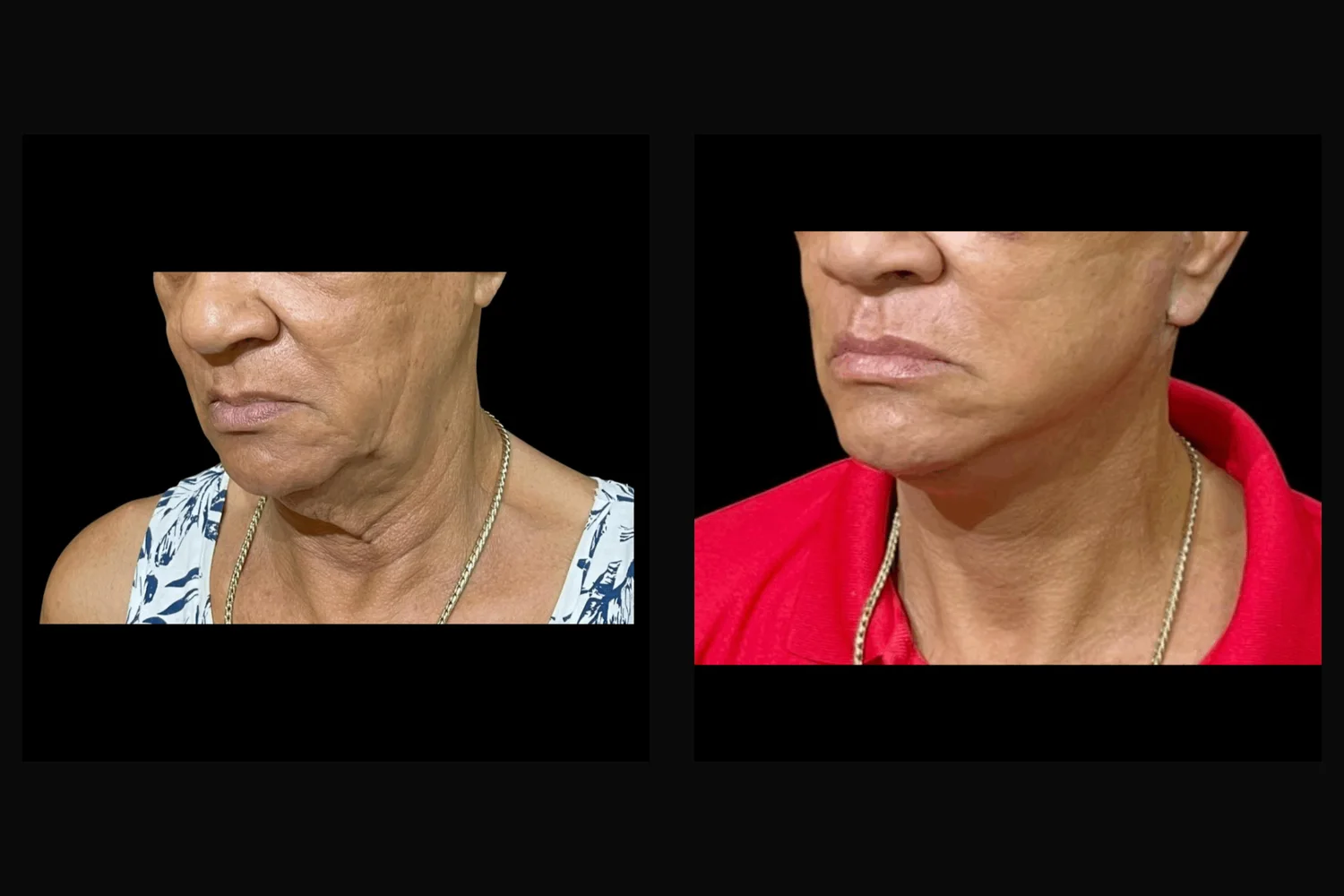 Lifting facial