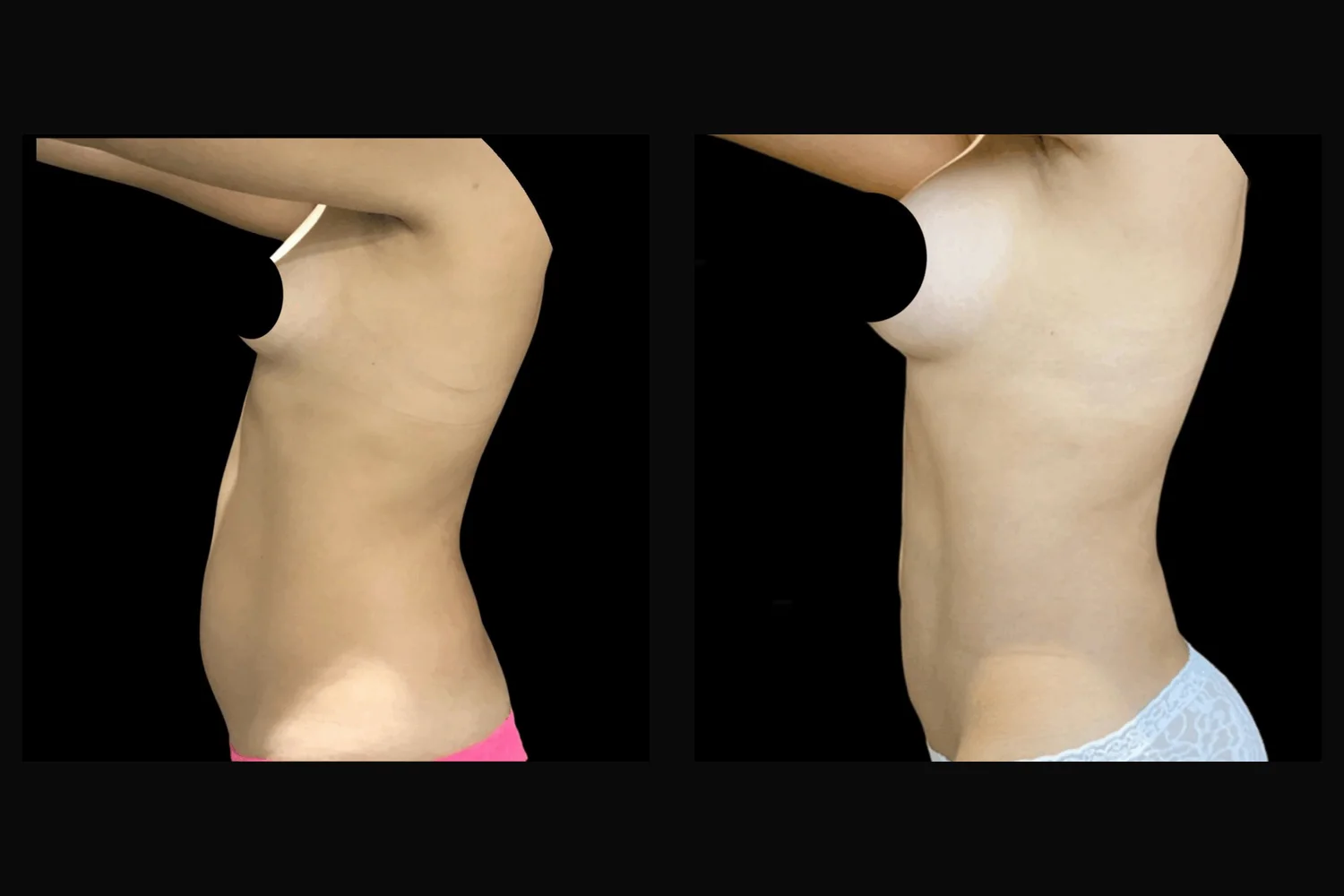 Lipoescultura