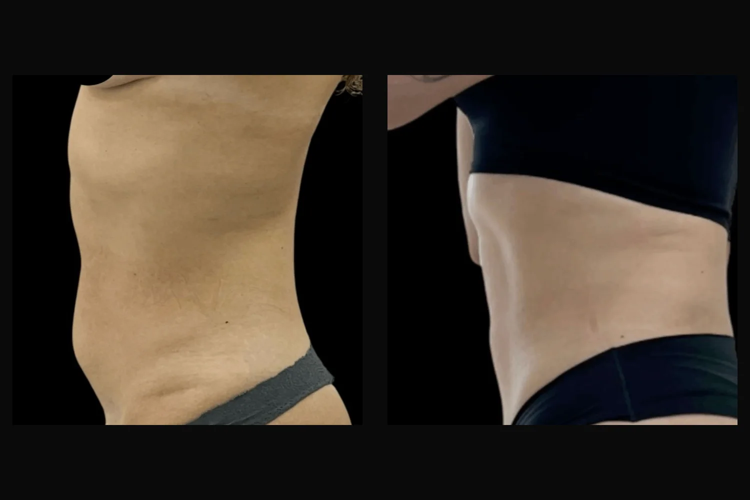 Lipoescultura