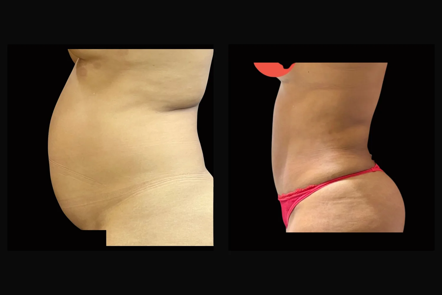 Abdominoplastia