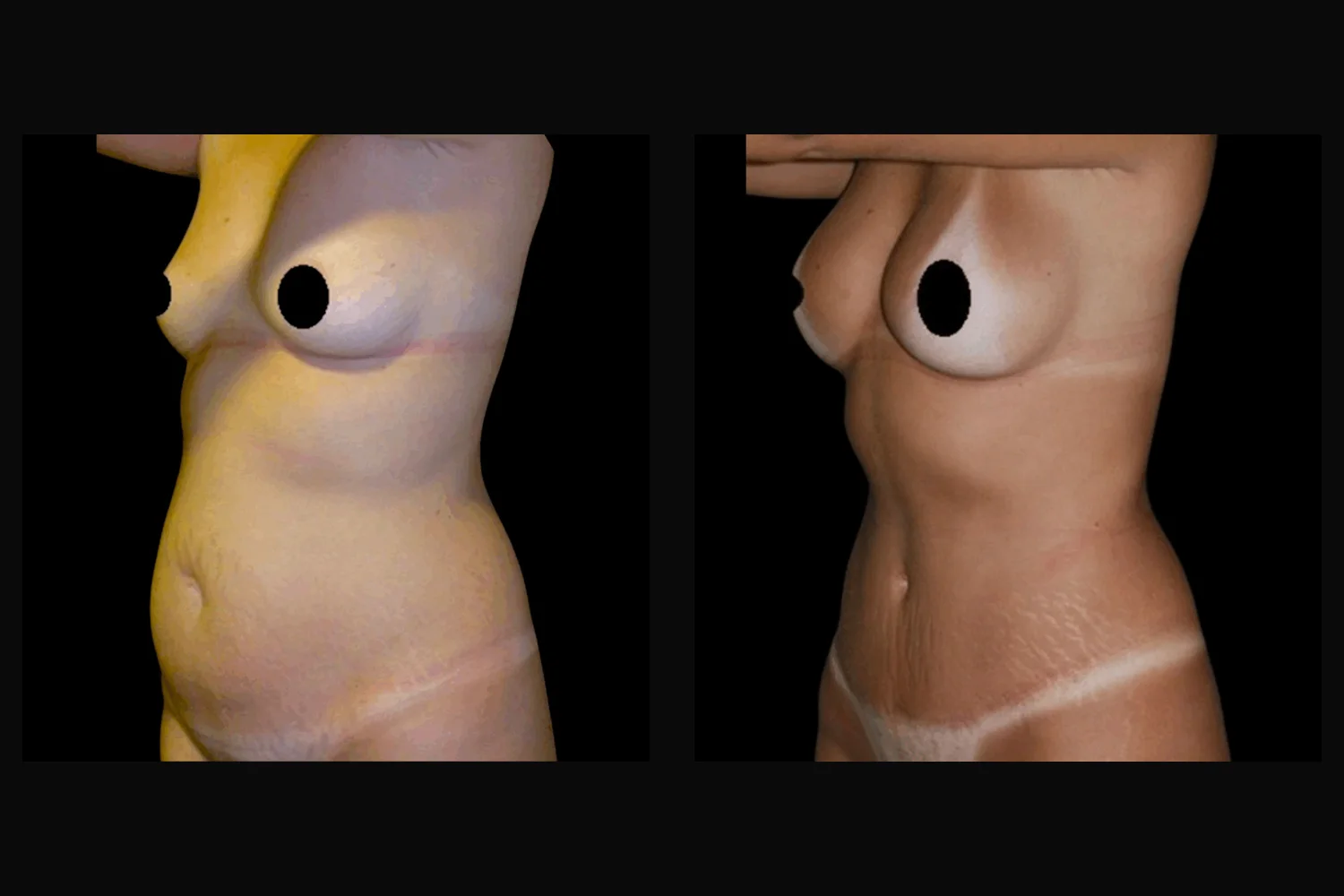 Abdominoplastia