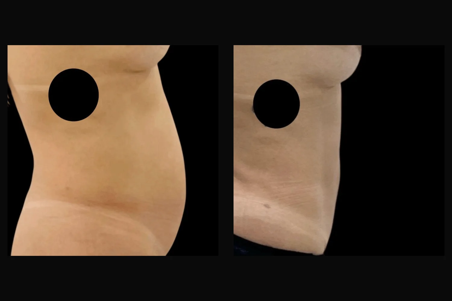 Abdominoplastia