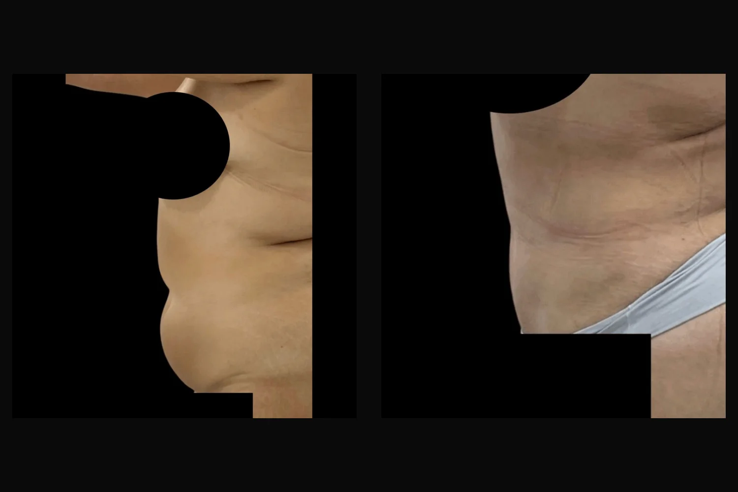 Abdominoplastia