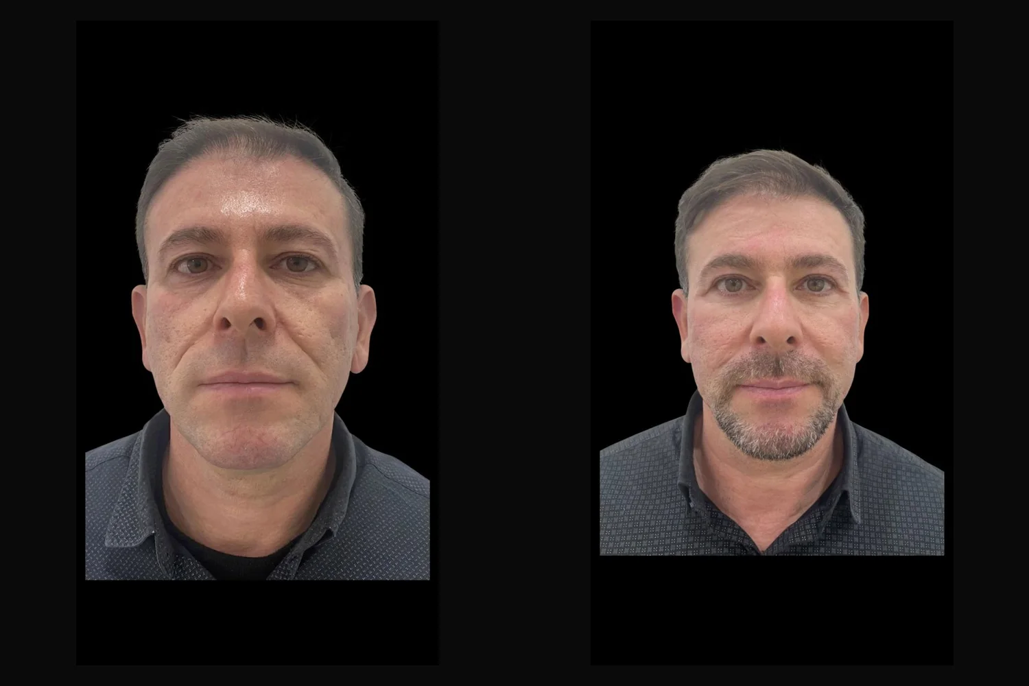 Armonización facial