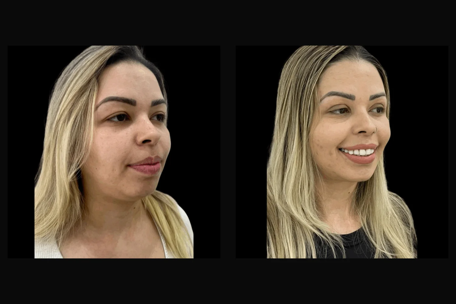 Blefaroplastia