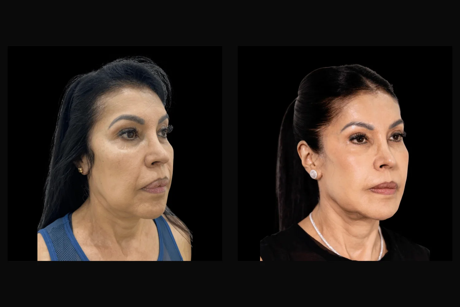 Lifting facial