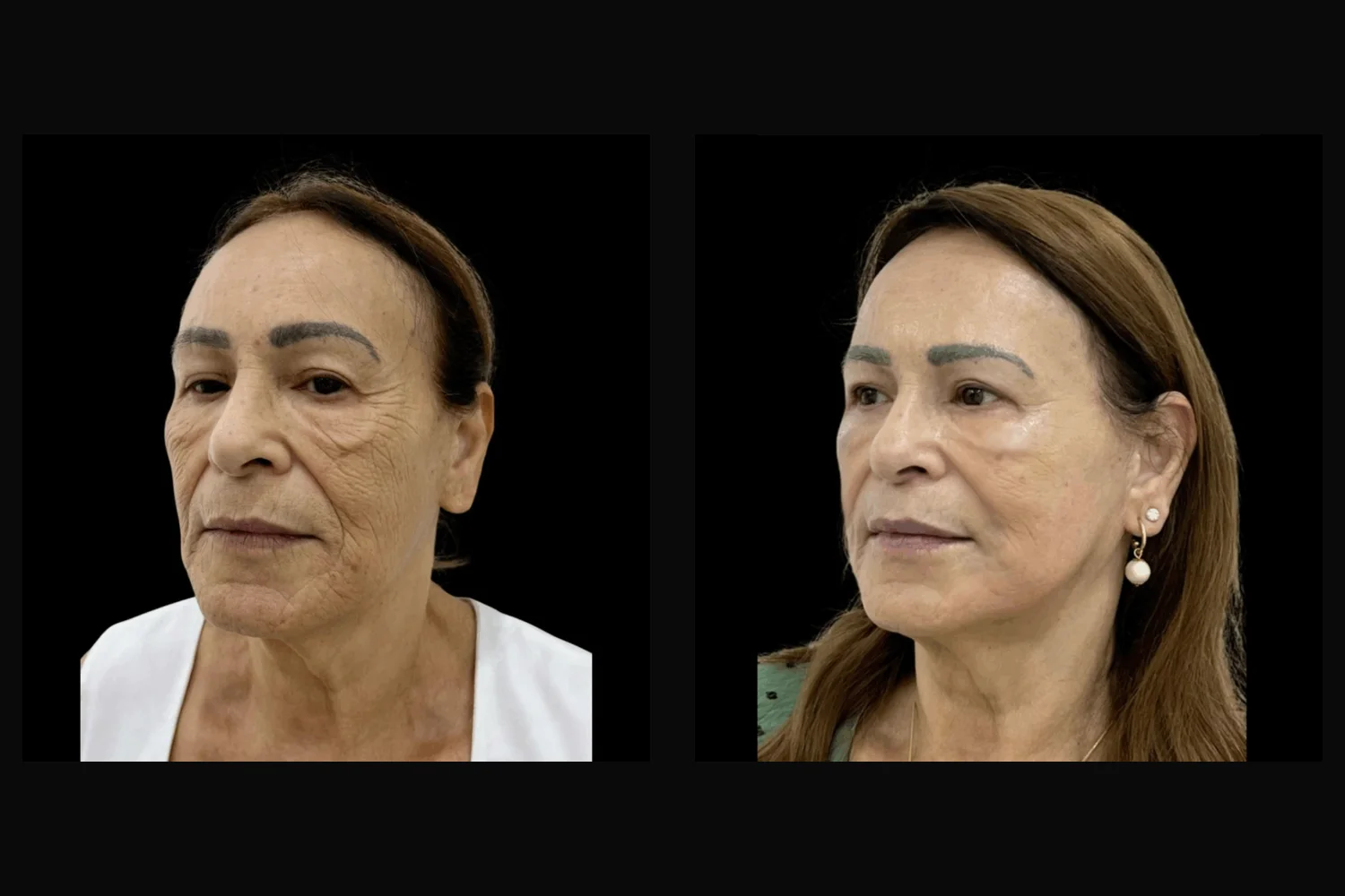Lifting facial