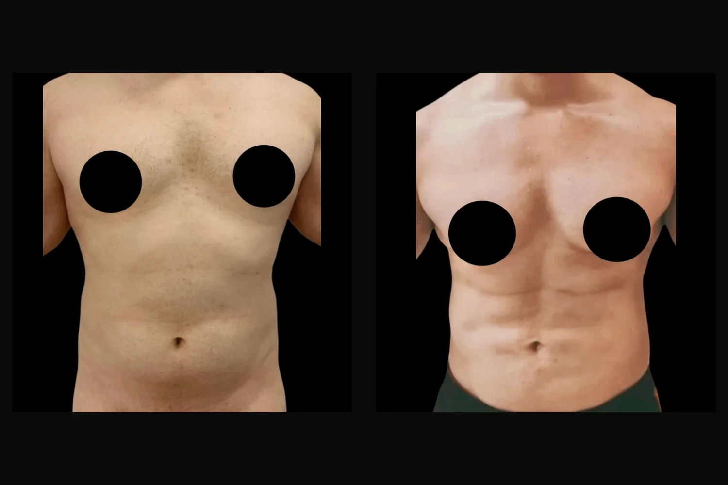 Lipoescultura
