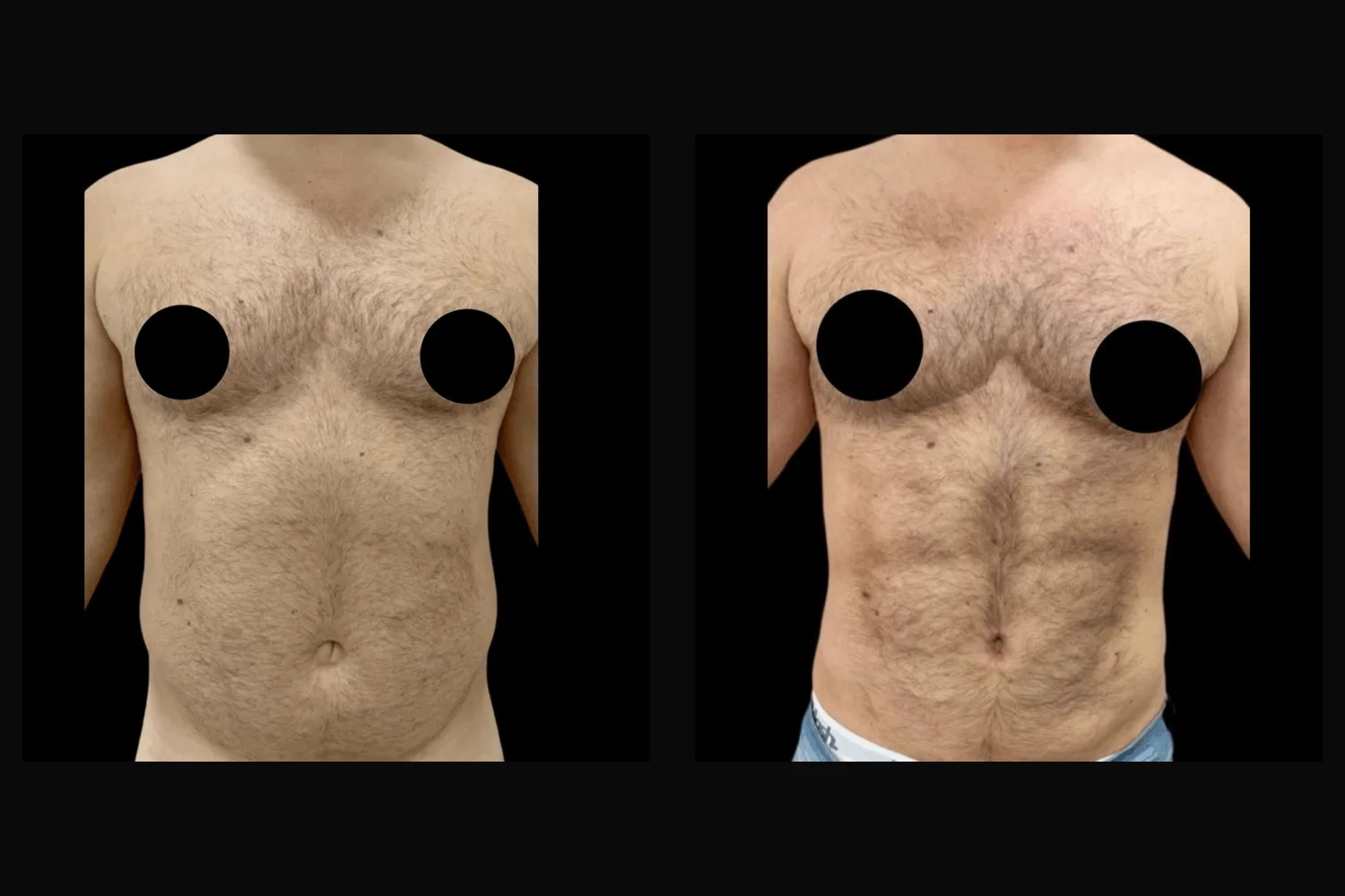 Lipoescultura