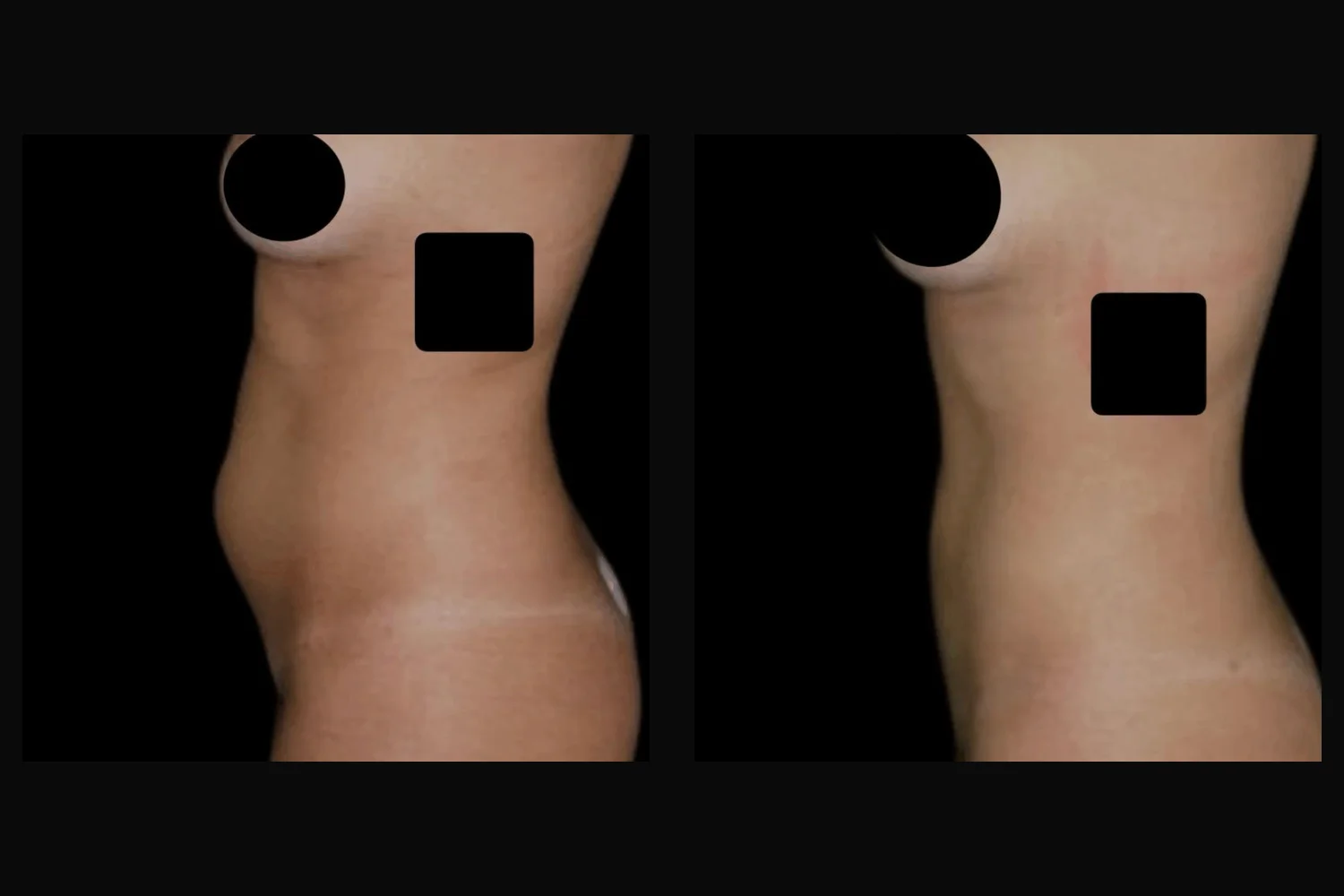 Lipoescultura