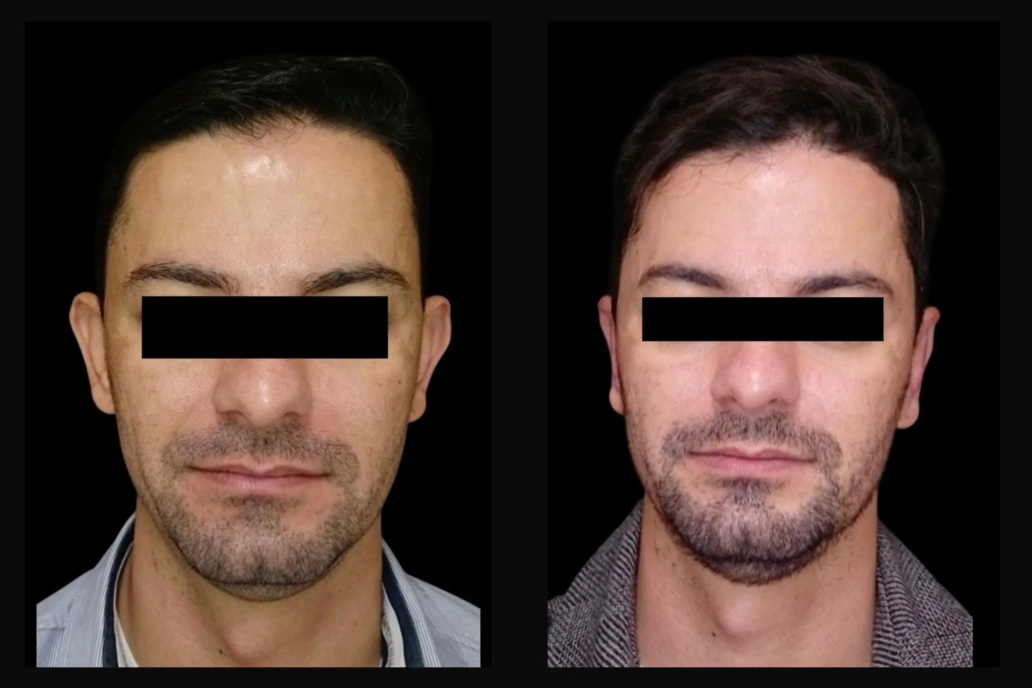 Otoplastia